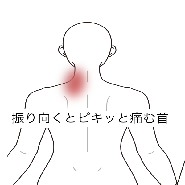 2週間前から左に振り向けない首の痛み｜寝違え（首の痛み）のツボ