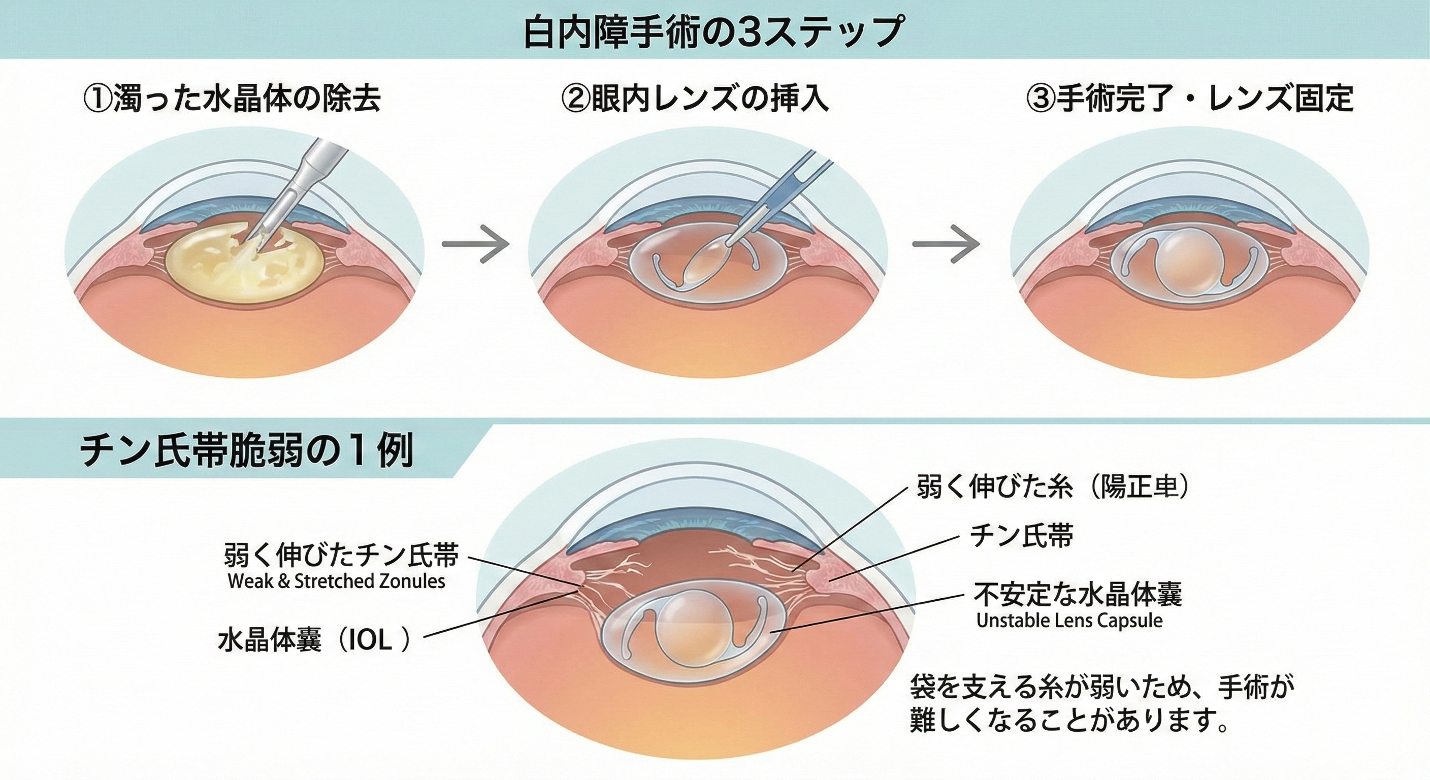 白内障手術をしたのによく見えない？その原因は？ | かなざわ土屋眼科