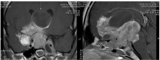 従来の経鼻手術(TSS)では困難な下垂体腫瘍に対する手術アプローチ
