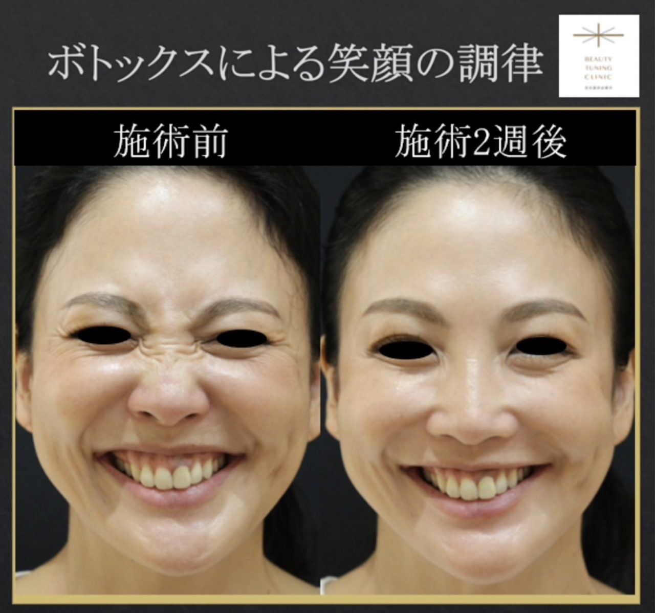 BTX-Tuning:ボトックスによる笑顔の調律 | 西田美穂のボトックスマニア