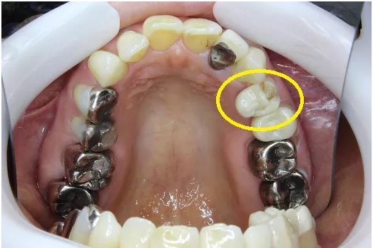 顎関節症への咬合治療について | 高崎市椿町の歯医者 内田デンタル