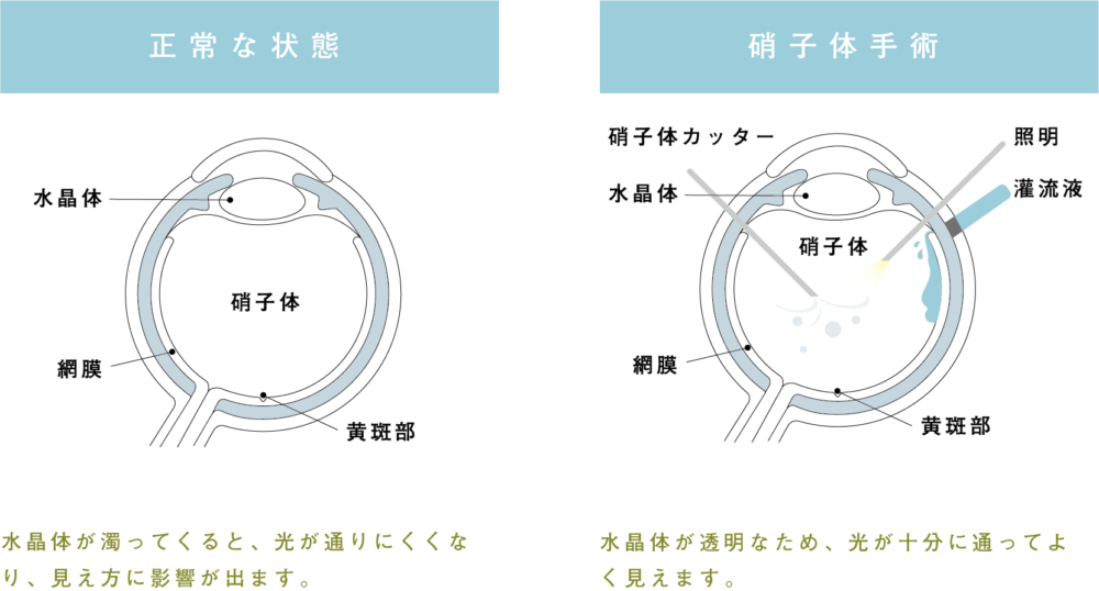 硝子体手術 - うぐいす眼科｜宝塚市の眼科 ｜日帰り白内障手術