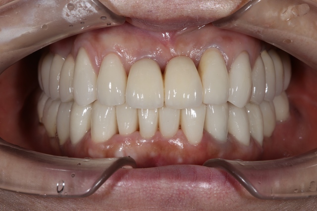 インプラント治療と補綴（セラミック）治療による咬合再構成 - 大阪駅