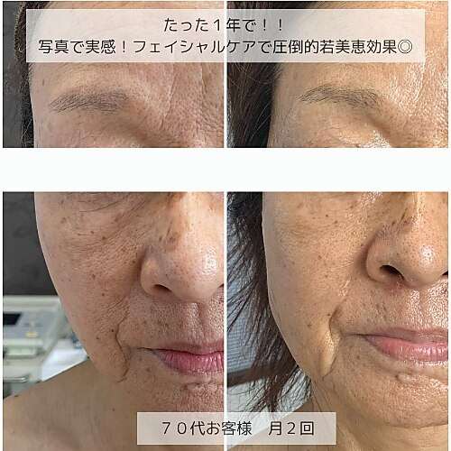 🌿リベルハーブピーリングの真価とは？他のハーブピーリングと比べて