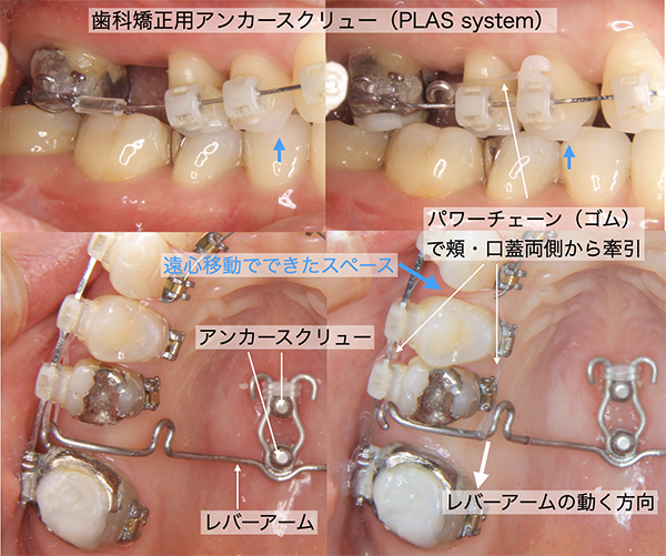 図6-2-歯科矯正用アンカースクリュー2 | SYNC横浜元町矯正歯科