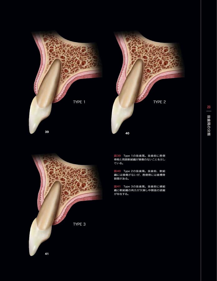 シングル・トゥースインプラント