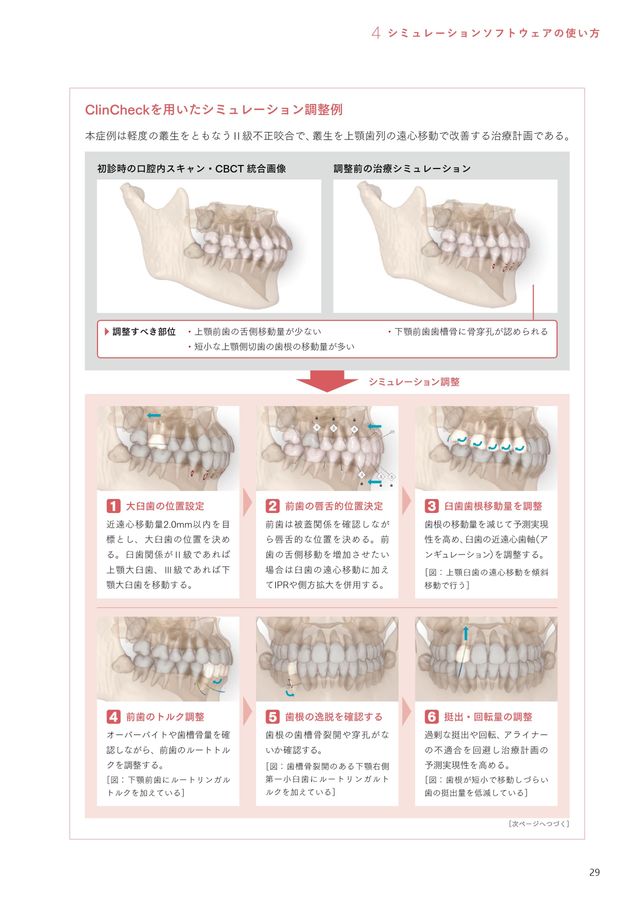 アライナー矯正治療戦略