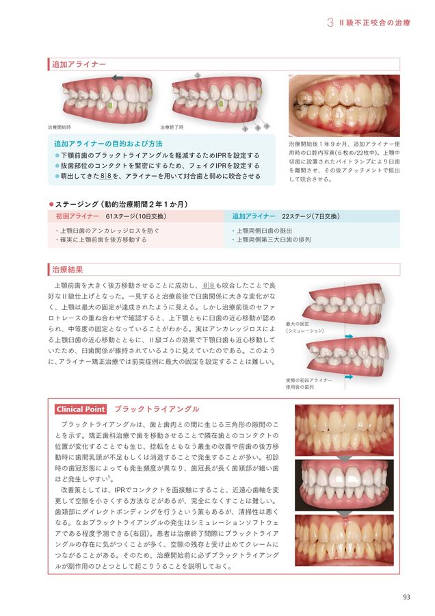 アライナー矯正治療戦略