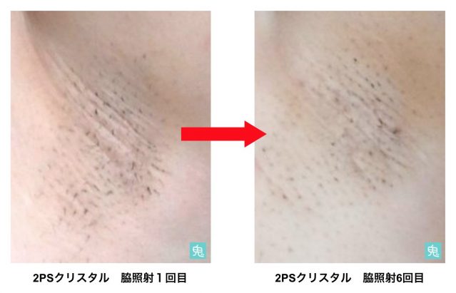 2PSクリスタル3ヶ月試した脱毛効果は？VIO・全身の口コミ評判を