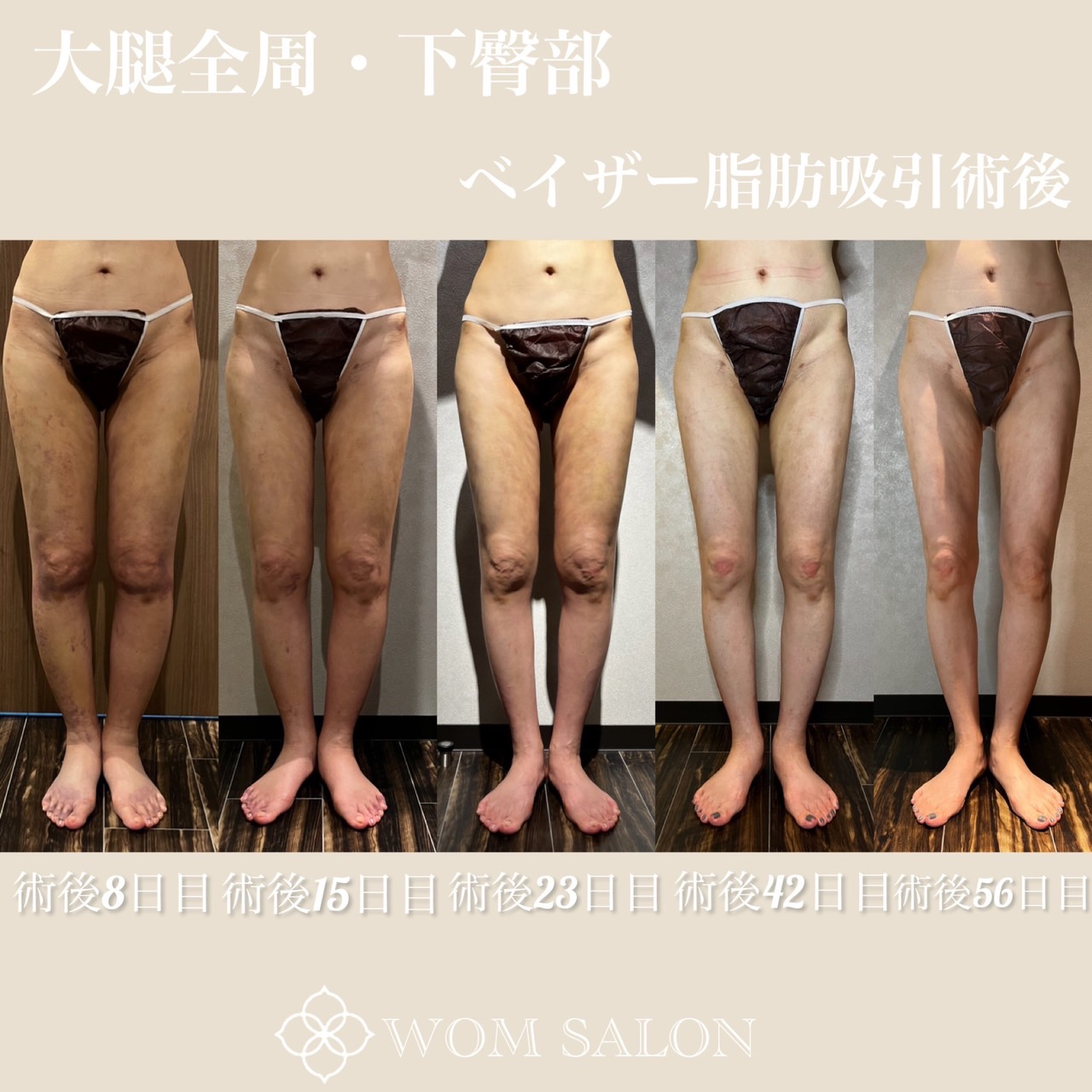インディバ術後ケア☆激変です(^^♪ No.88｜WOM SALON(ワムサロン)