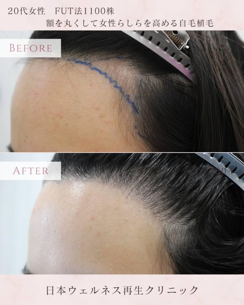 植毛とは？方法・種類・費用・経過・リスクまでわかる完全ガイド