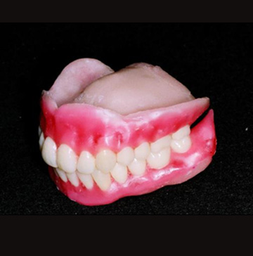 義歯（GDSデンチャー） | セント歯科 - 大分県別府市の歯医者さん歯周