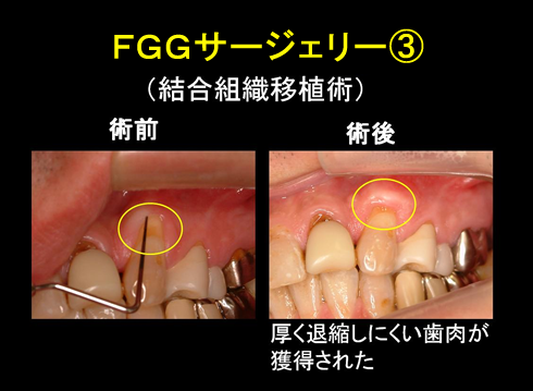 歯周外科治療｜横浜市 新横浜駅近くのセントラル歯科｜セラミック