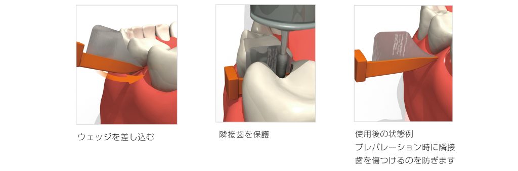 商品情報｜医療従事者向けページ｜歯科器材のクロスフィールド