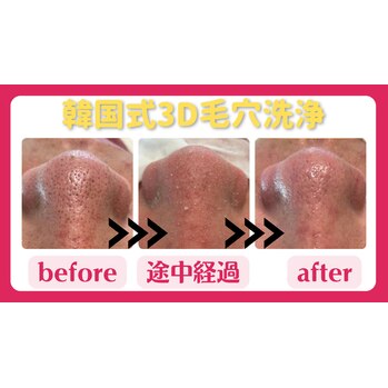ごっそり浮かせてきれいに！韓国式3D毛穴洗浄 - AMAZING HAIR