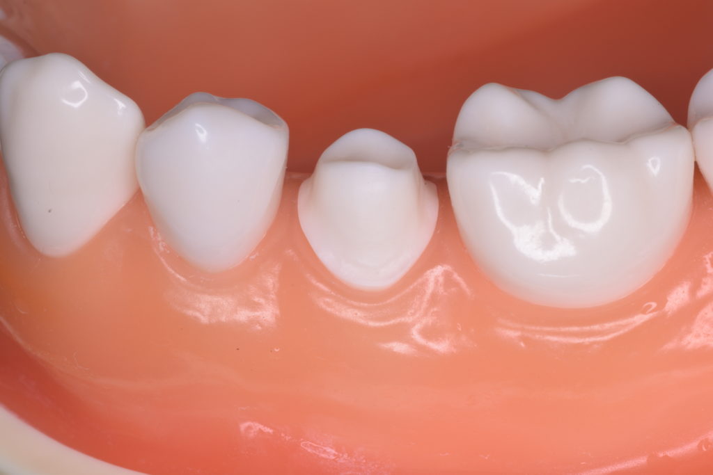 再製のない修復治療のために①・・・スムーズな支台歯形成｜世界レベル