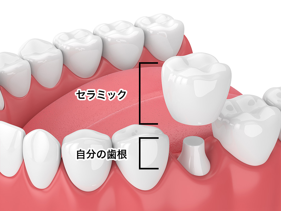 インプラントとセラミックの違い | 赤坂の美容歯科・審美歯科・歯医者
