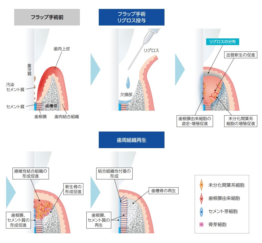 リグロスによる歯周病で破壊された歯槽骨の再生方法 | あいざわ歯科
