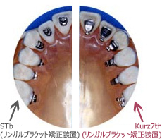 リンガルブラケット矯正装置（Kurz7th）｜赤羽矯正歯科｜日本矯正歯科