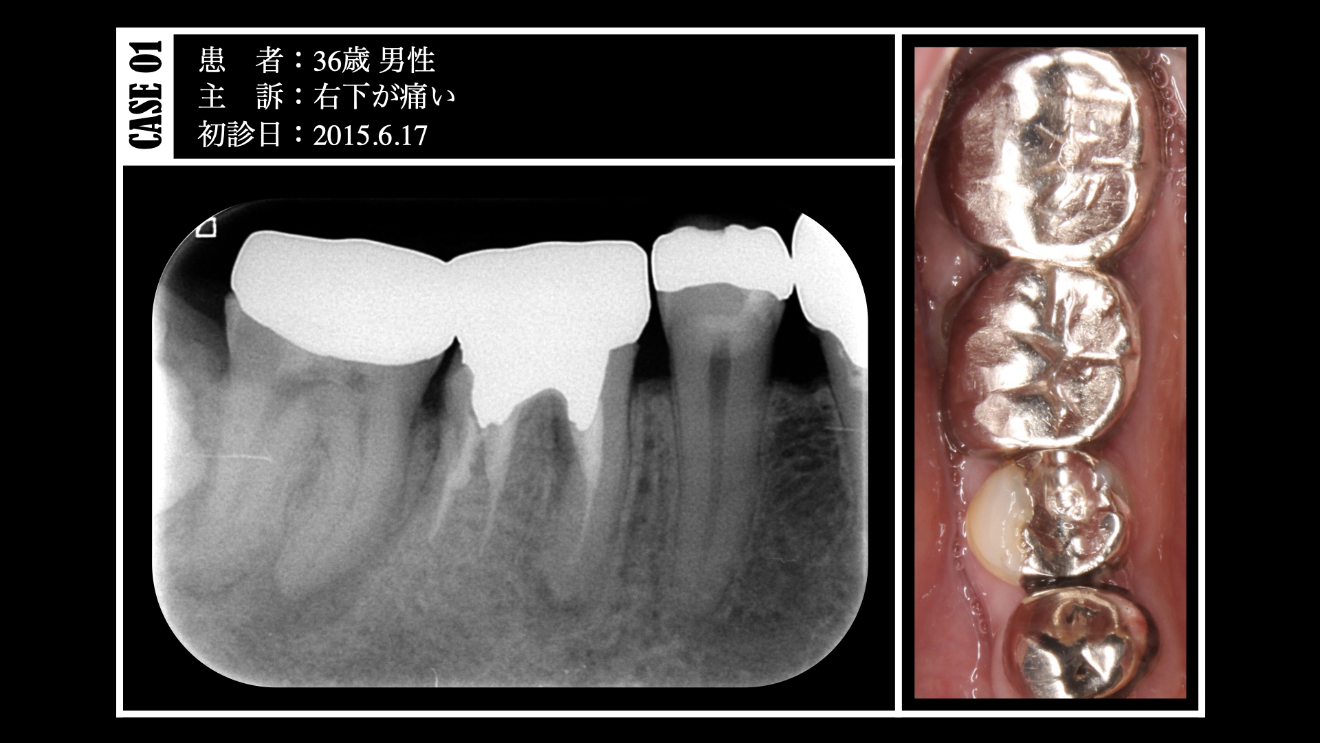 歯内-歯周(エンドペリオ)病変に罹患した歯の治療｜福岡市東区香椎浜の