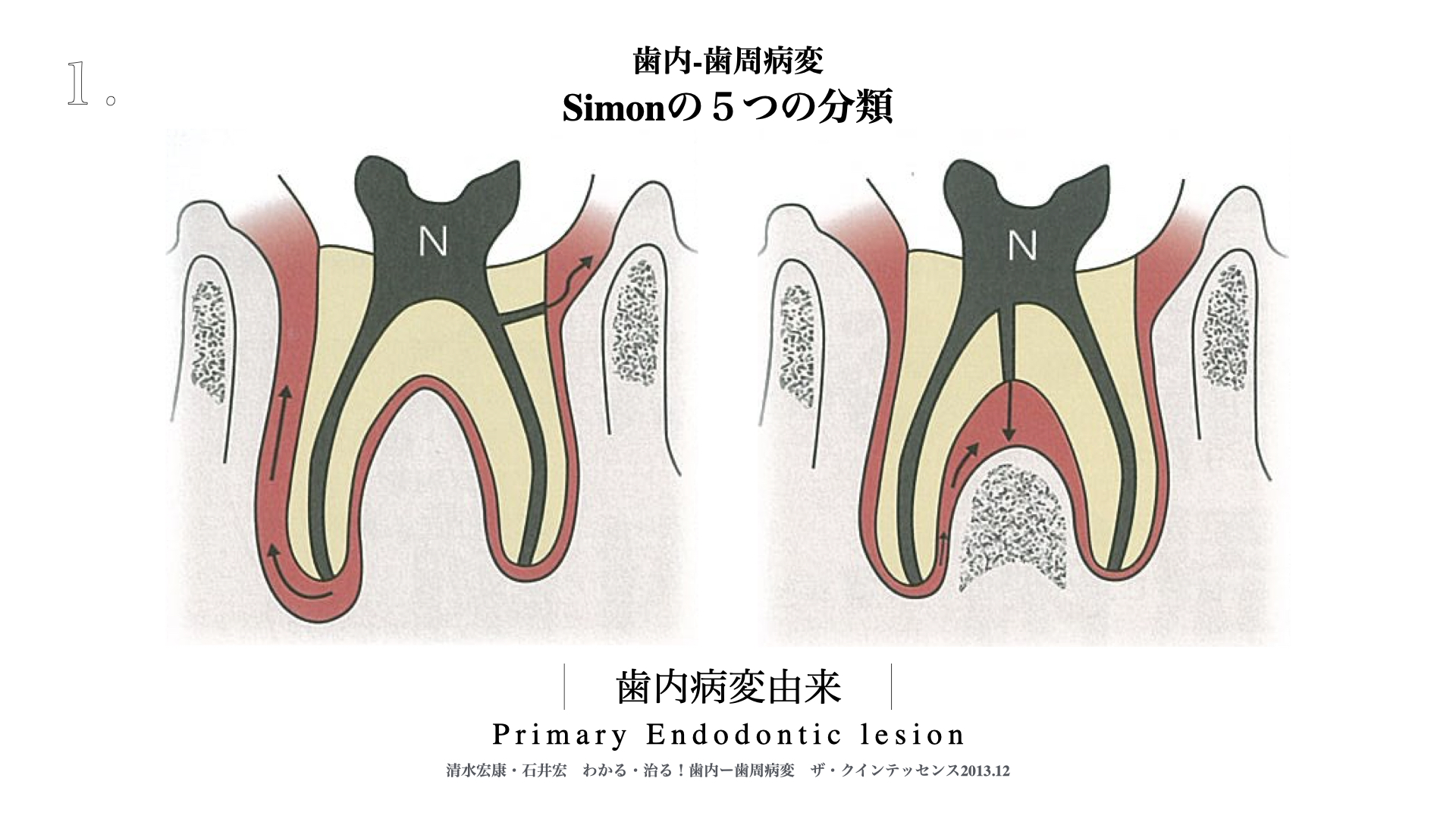 歯内-歯周(エンドペリオ)病変に罹患した歯の治療｜福岡市東区香椎浜の