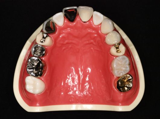 患者様説明用模型 – 【公式】広島市の歯科技工所「株式会社アート