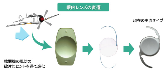 眼内レンズ｜白内障と眼内レンズ手術