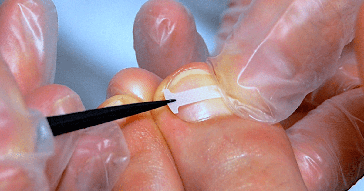 巻き爪補正B/Sスパンゲ | 兵庫県姫路市 足楽（あしらく）のHP