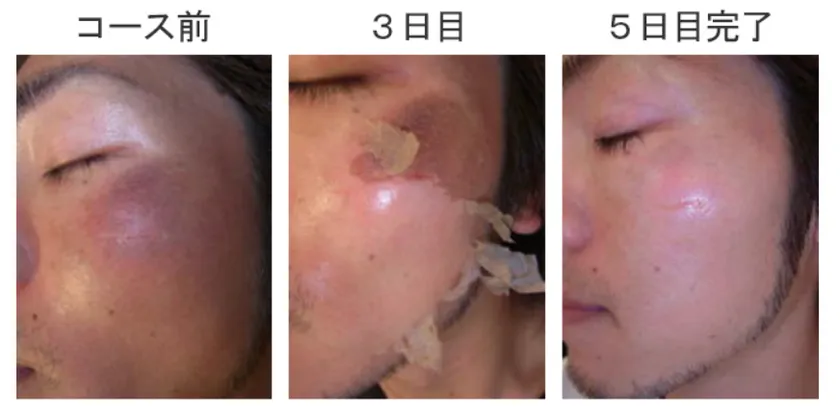 ハーブピーリングの王道「ハーバルピール」の専門店 EXSIALEが、期間