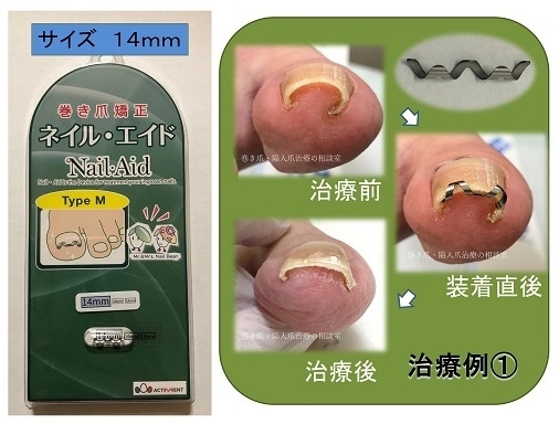 専門医師が開発した巻き爪矯正器具「ネイルエイド」で 2万人以上の