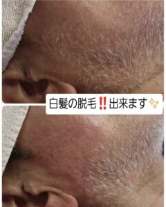 ⚠️ VIOの白髪に後悔！「あの時」知っておきたかったこと