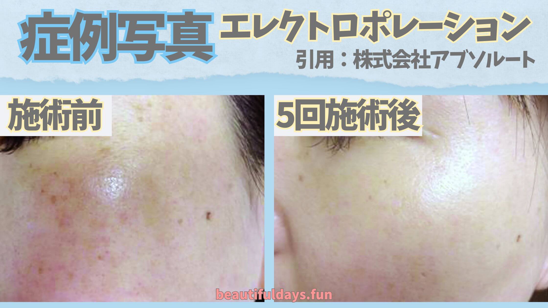 SBC湘南美容クリニック／体験ブログ！エレクトロポレーションの効果で