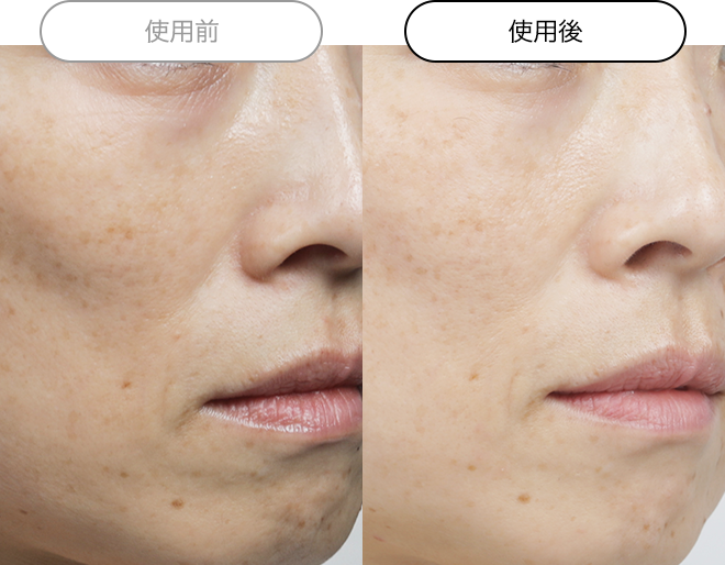 ビーグレン クエスクVC5&VA5&HQ5 高濃度美容液 クエスク メディックス