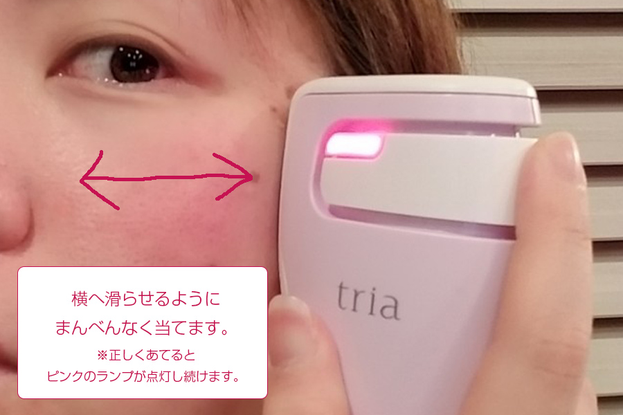 before・afterで検証】トリア・スキンエイジングケアレーザーの体験