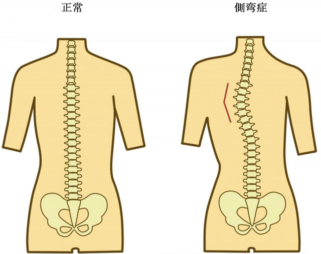 側弯症改善に三半規管トレーニング | 高槻市「ぎの整体院」／医師推薦