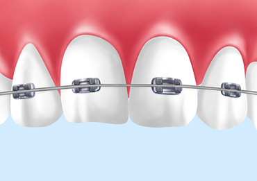 矯正のと費用｜田園歯科クリニック｜中央林間駅から徒歩30秒と近い