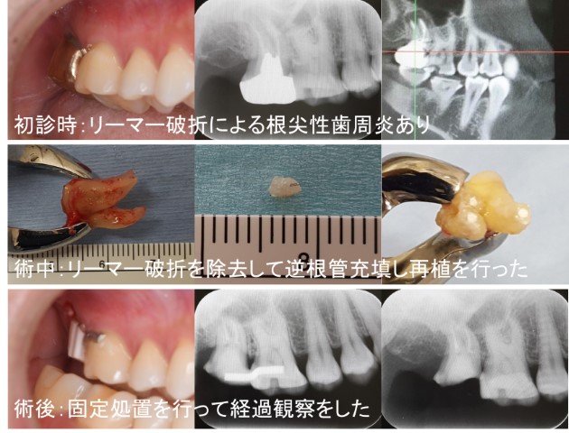 歯の移植と再植について【患者様向け】 | 歯と口腔外科の役立つお話