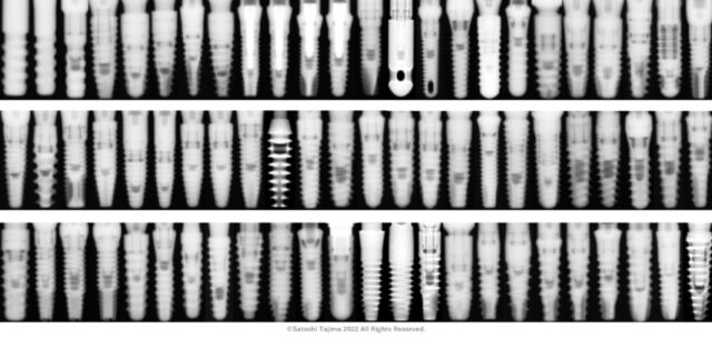 インプラント102種類の一覧と見分ける項目について | 歯と口腔外科の