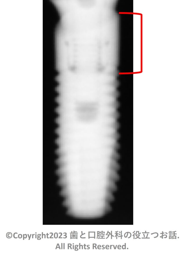 Astra Tech Implant OsseoSpeed Profile EVについて | 歯と口腔外科の