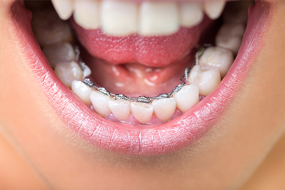 裏側矯正（舌側矯正）｜大阪・豊中・吹田の矯正歯科｜吉村矯正歯科