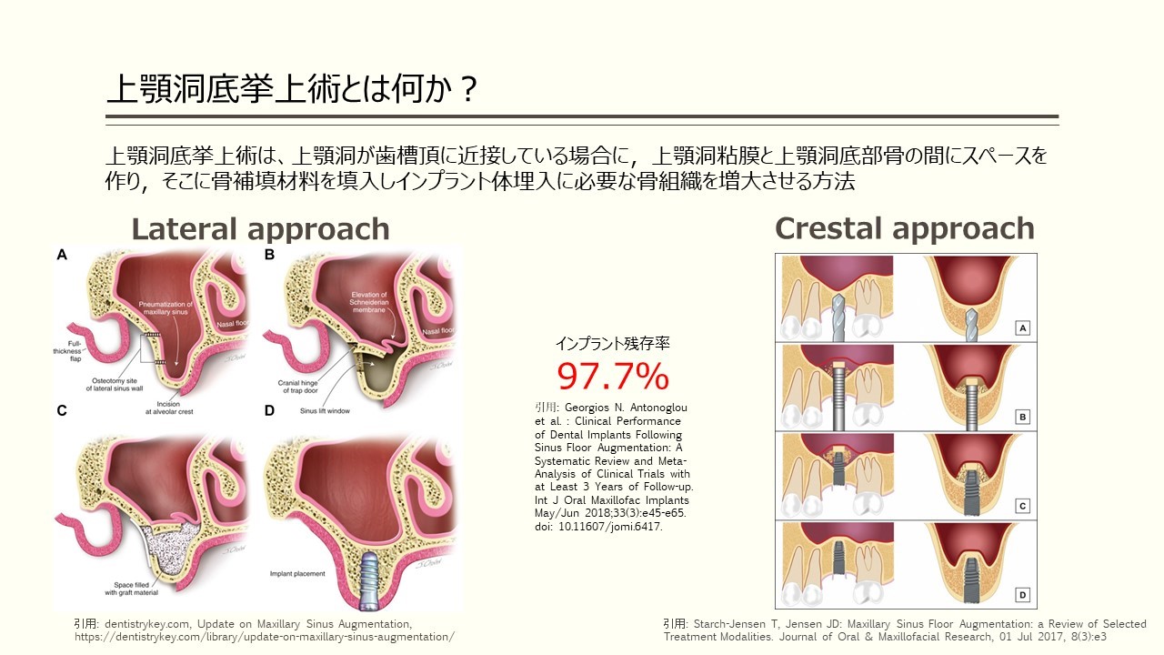 上顎洞底挙上術に関するQ&A上顎洞底挙上術に関するQ&A - 新谷悟の歯科
