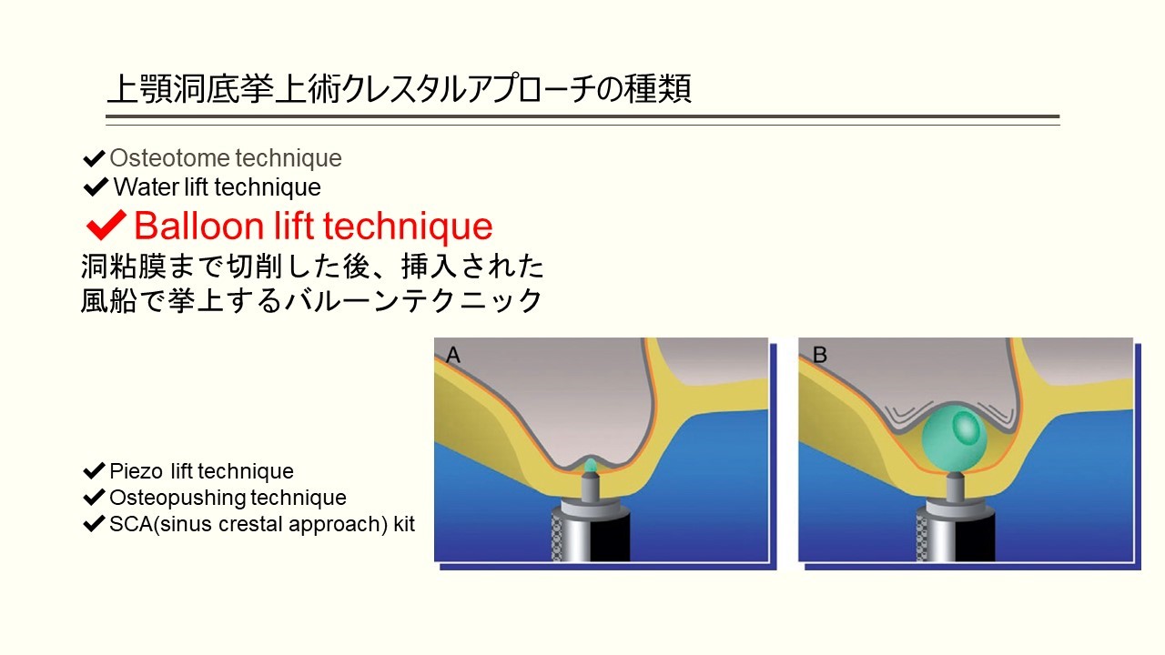 上顎洞底挙上術に関するQ&A上顎洞底挙上術に関するQ&A - 新谷悟の歯科