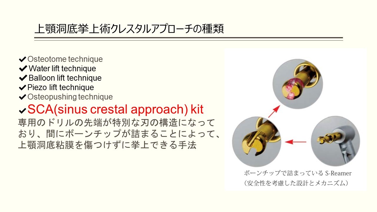 上顎洞底挙上術に関するQ&A上顎洞底挙上術に関するQ&A - 新谷悟の歯科