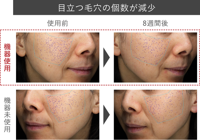 e-TREND｜パナソニック EH-SL85-W [光美顔器フォト ブライトショット]