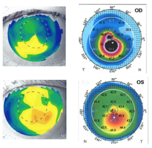 円錐角膜の治療 コラーゲン・クロスリンキング - 遠谷眼科｜白内障