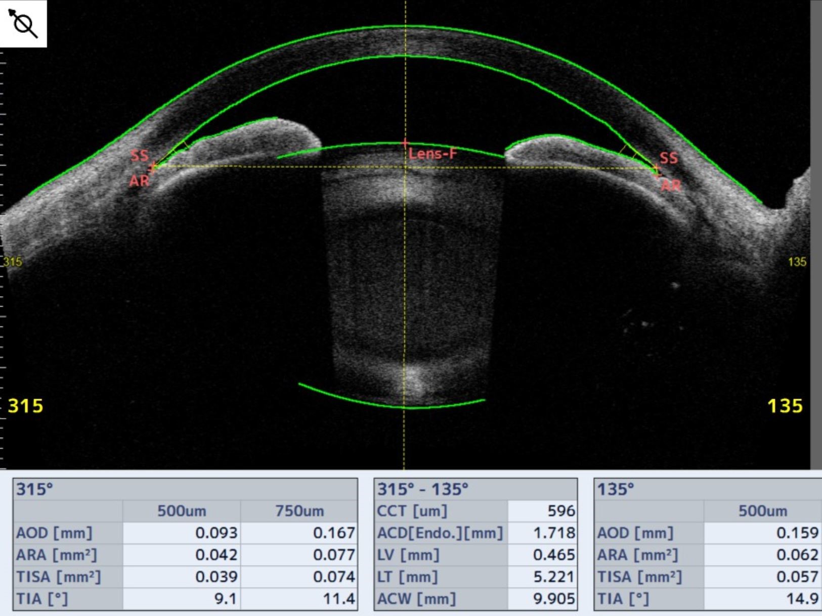 原発性閉塞隅角症/閉塞隅角緑内障/急性緑内障発作 | えのき眼科｜埼玉