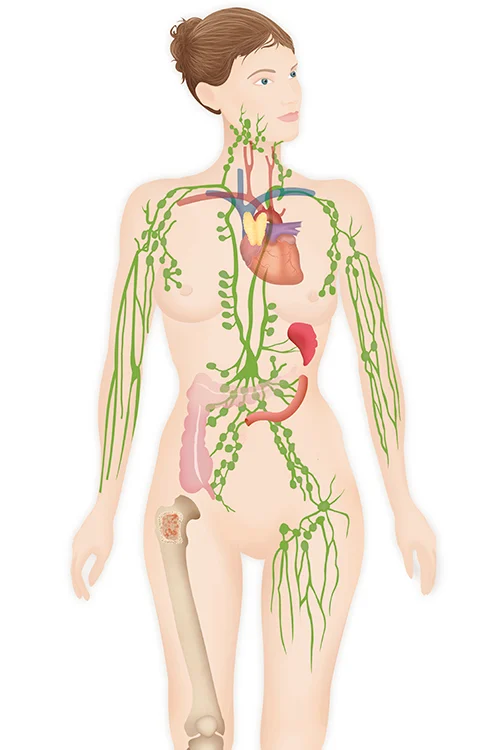 Center For Lymphatic Surgery In New Jersey | ECAPS