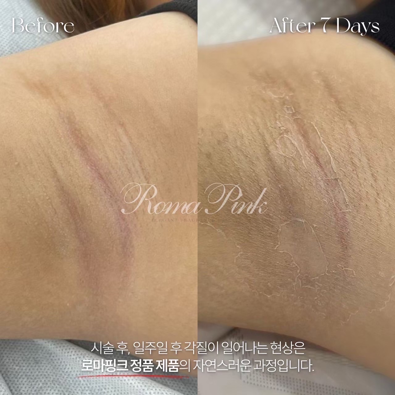 ローマピンク（Roma Pink）｜美容皮膚科エルムクリニック