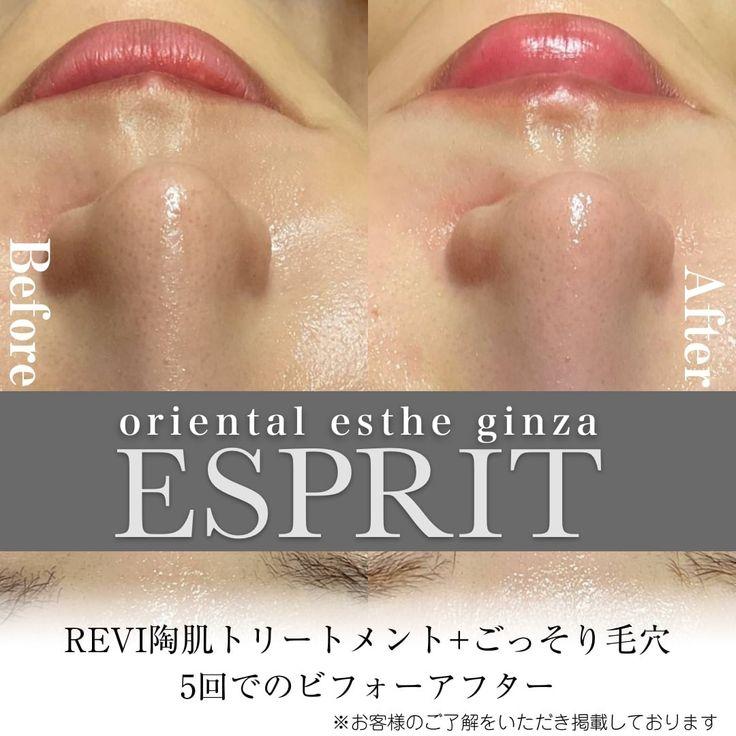 ハーブピーリングREVI【ルヴィ】陶肌トリートメント ｜東京銀座、新宿