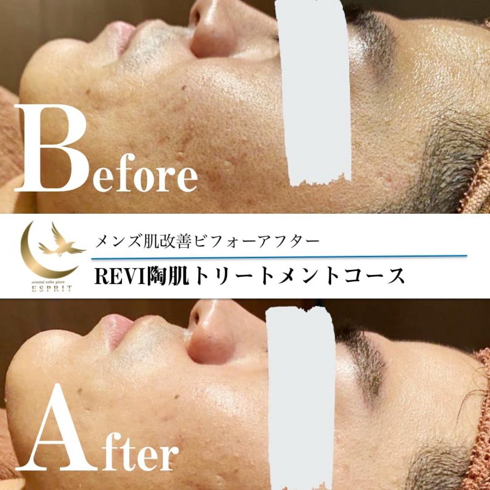 REVIハーブピーリングトリートメント【オム】 ｜東京銀座、新宿の